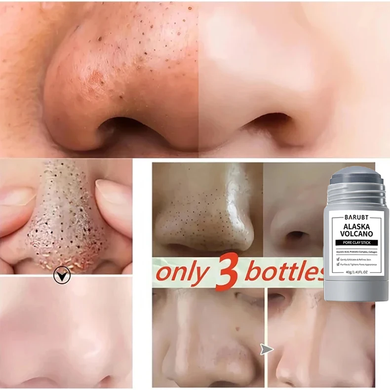 Mascarilla sólida anti-espinillas: ¡adiós a los puntos negros!