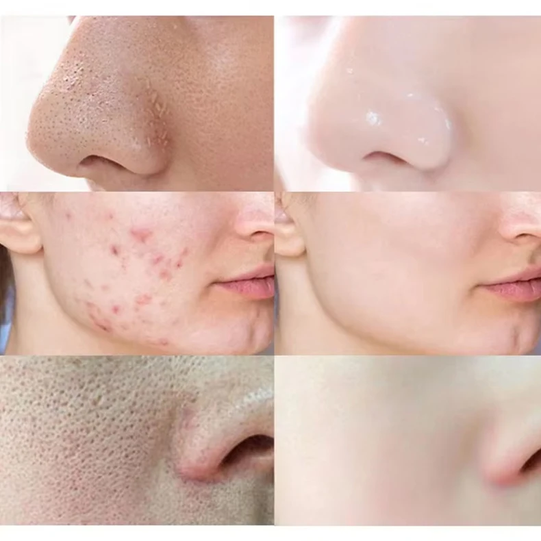 Mascarilla sólida anti-espinillas: ¡adiós a los puntos negros!